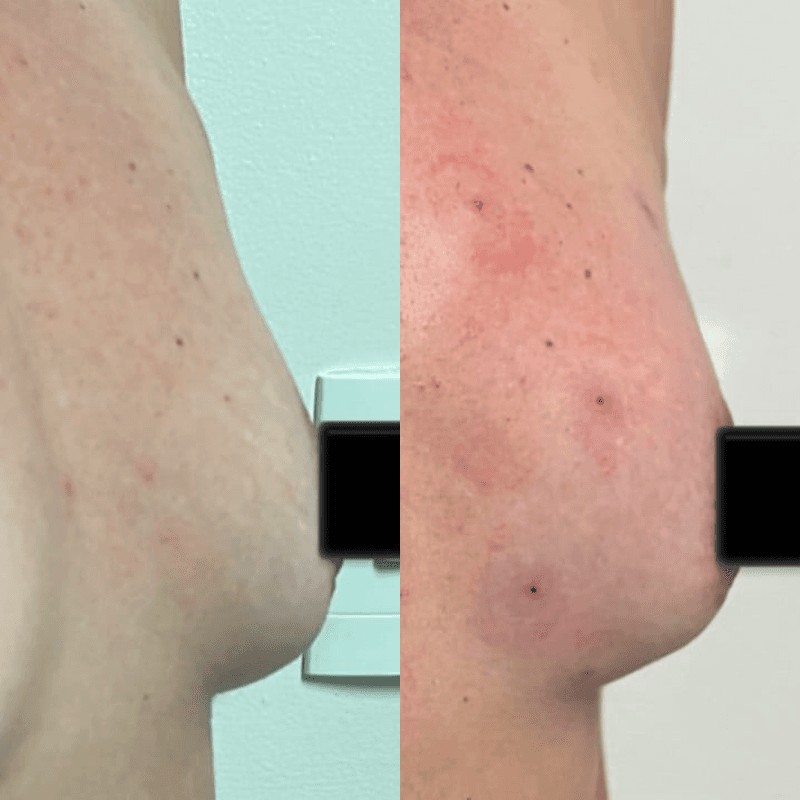 Antes e depois de Preenchimento de seio