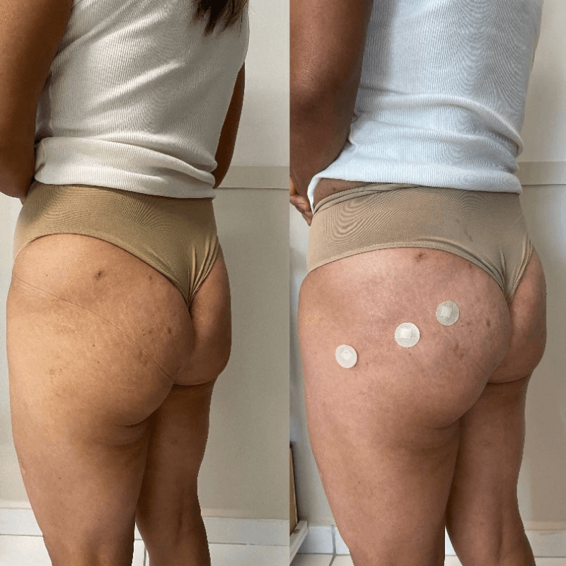 Antes e depois de Preenchimento de glúteo