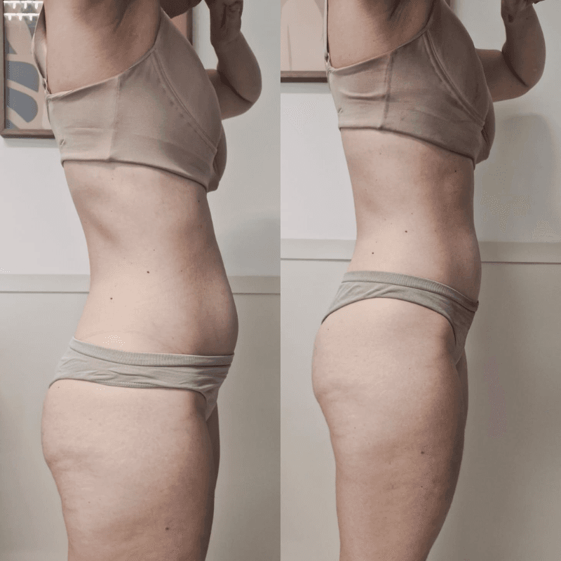 Antes e depois de Drenagem Linfática