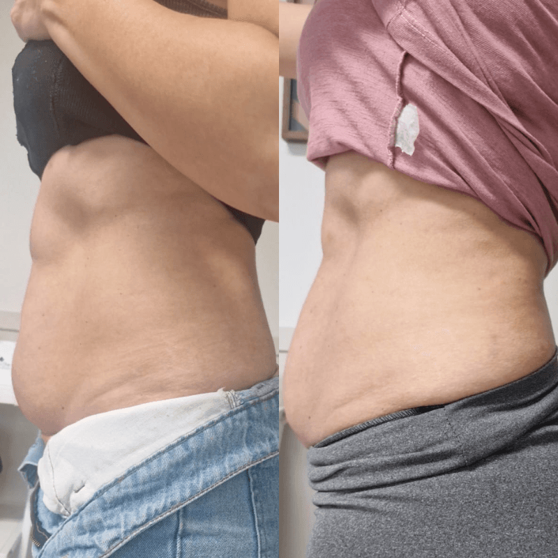 Antes e depois de Ultrassom + Enzimas Emagrecedoras