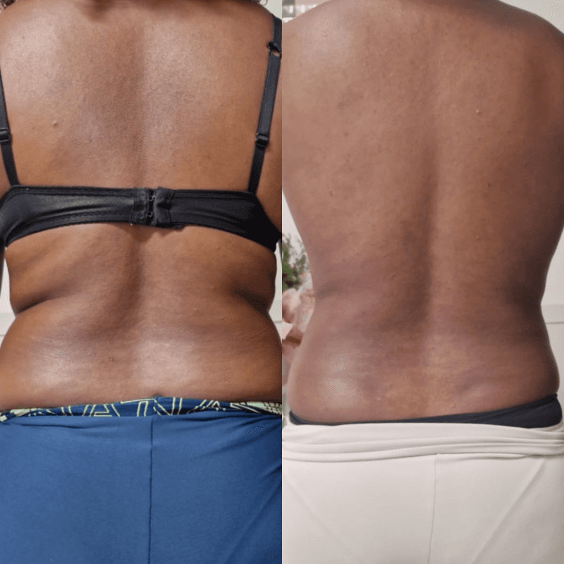 Antes e depois de Hidrolipoclasia