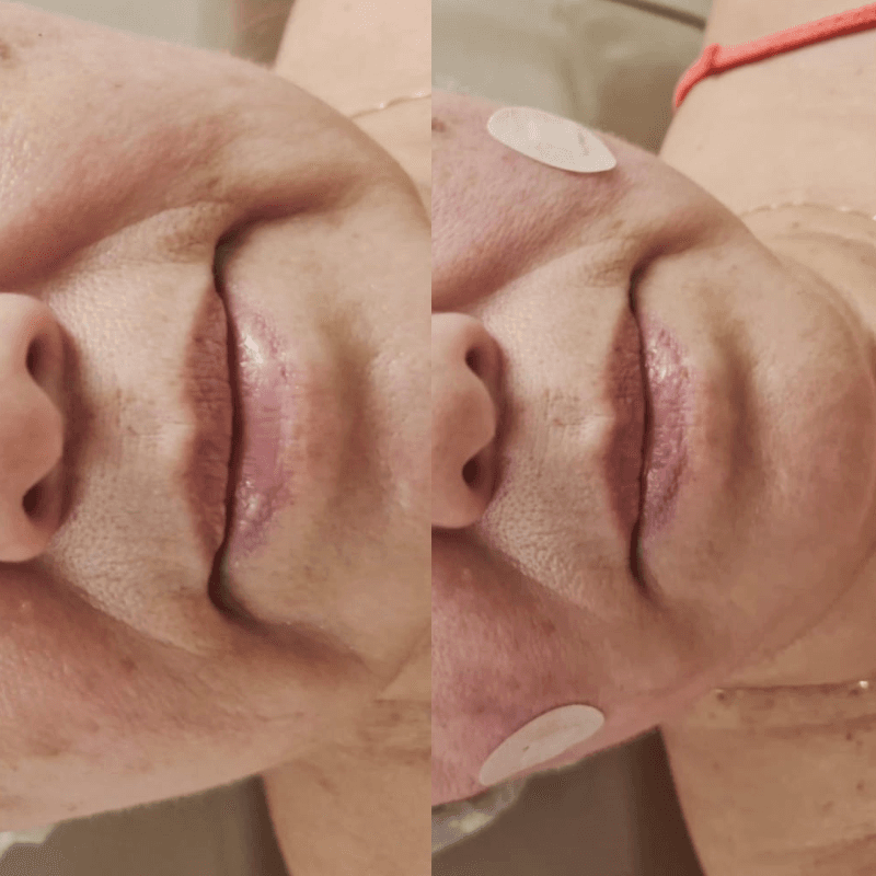 Antes e depois de Fios de Sustentação